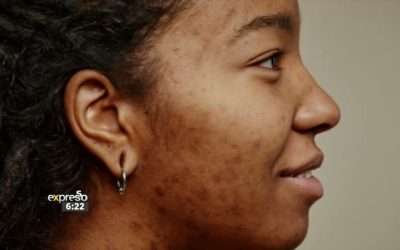 Youth Health  Dealing with Acne, Skin Confidence & Hormones