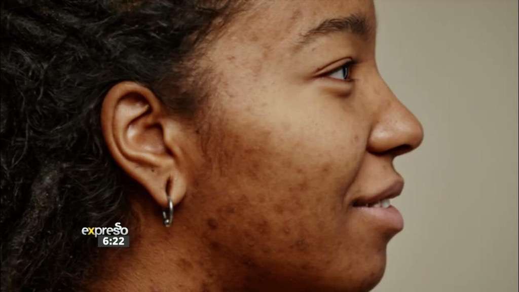 Youth Health  Dealing with Acne, Skin Confidence & Hormones